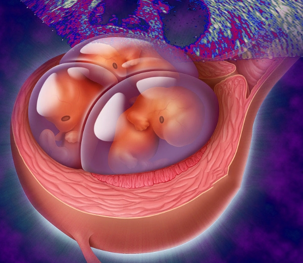 泰州供卵助孕高端机构-泰国第三代试管婴儿：避免囊胚培养的多胎妊娠(图1)